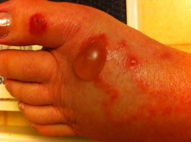 Blistered Foot